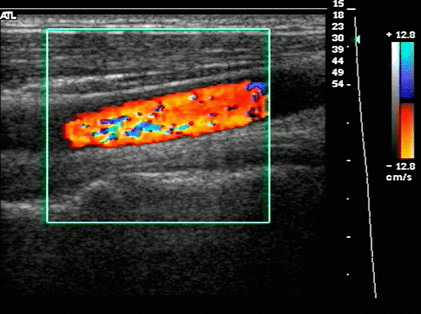 색조 도플러 초음파 영상