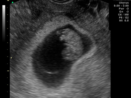 초기 임신 경질 초음파 영상