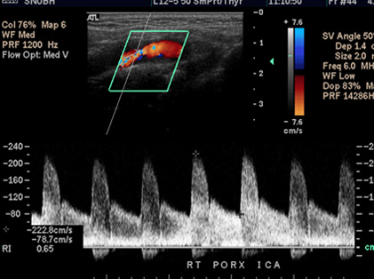 분음 도플러 초음파 영상