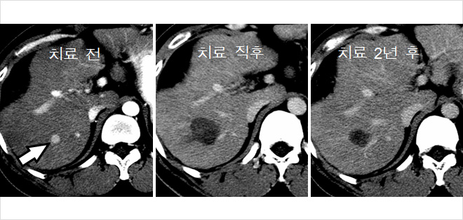 고주파열치료 치료전후